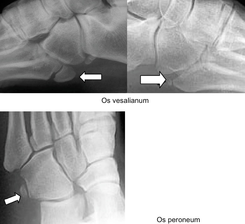 Figure 3 for case Fifth metatarsal base injuries